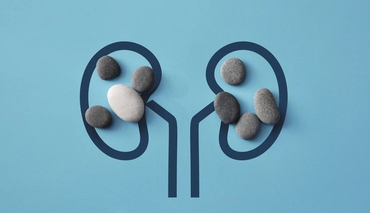 Obat Penghancur Batu Ginjal